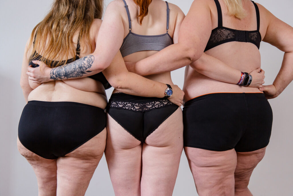 Información sobre el lipedema